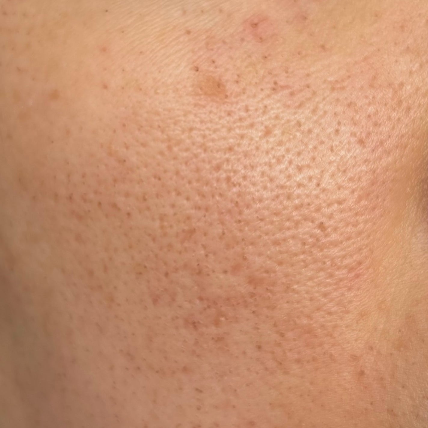 DRX AZAクリア/ロート製薬/その他スキンケアを使ったクチコミ(6枚目)