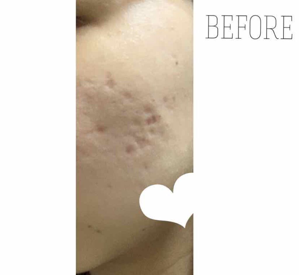 Cちゃん on LIPS 「ダーマペン 4ヶ月半 経過お久しぶりです✌️地道にダーマペンを..」(2枚目)