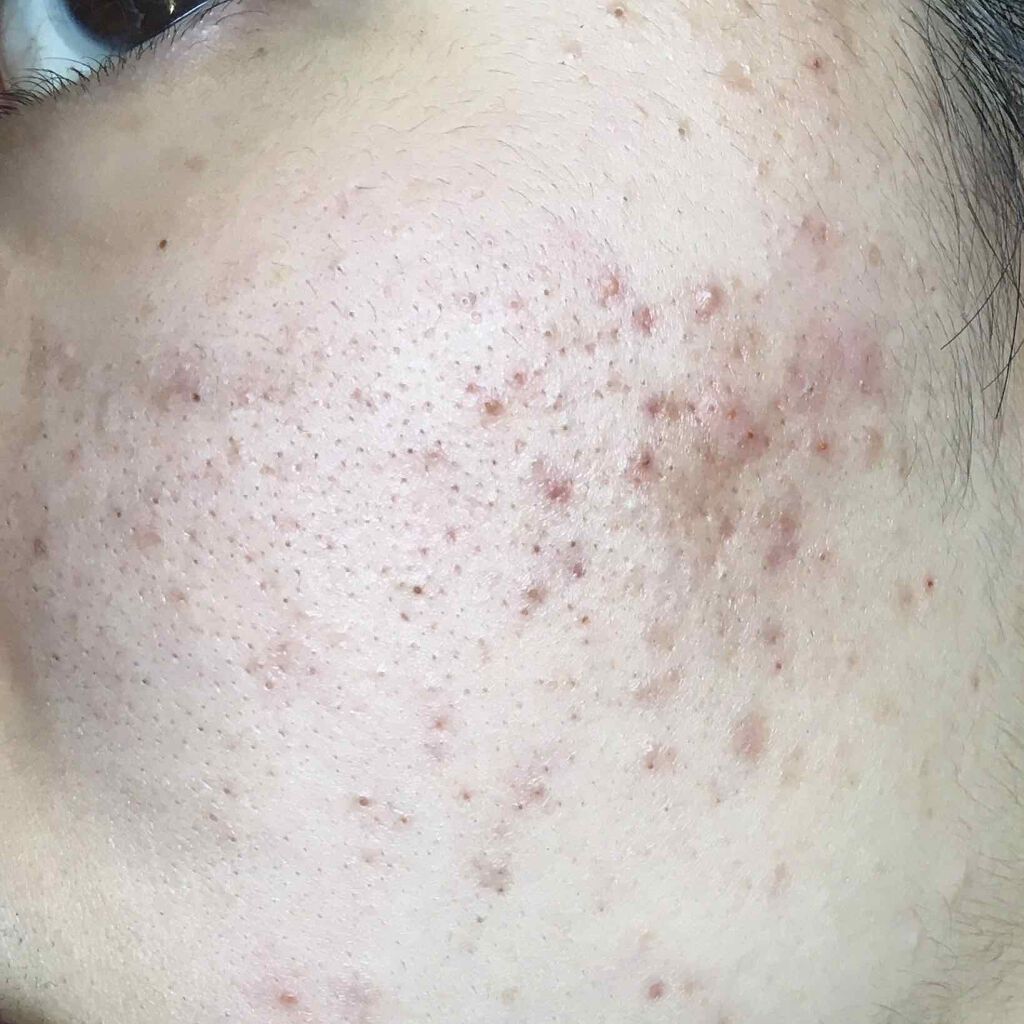 shiny_gloss_2az on LIPS 「高一女子です。この汚い肌、何しても治らないです、、毛穴詰まりま..」(2枚目)