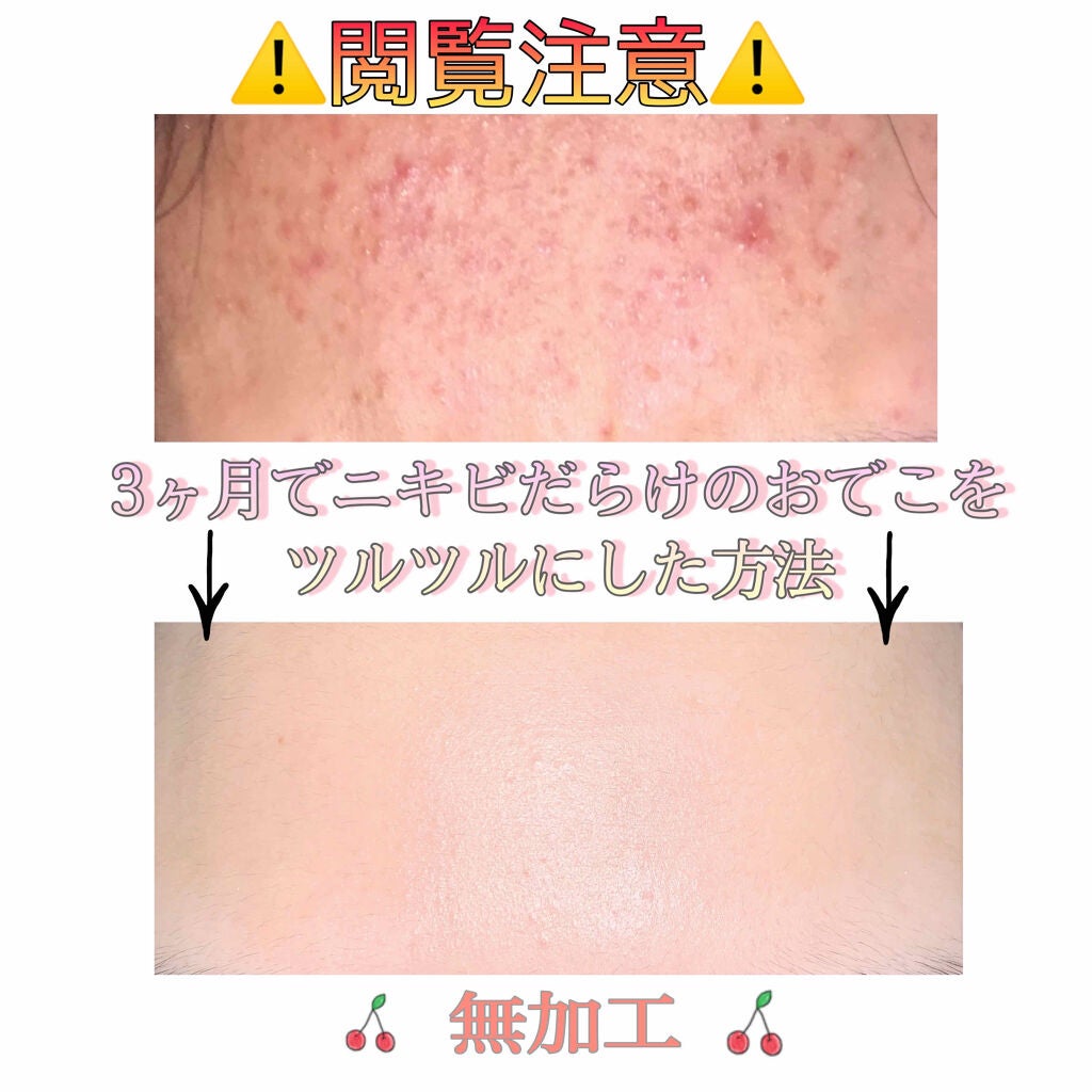 Ⓜ︎un on LIPS 「..私がぶつぶつなおでこをツルツルにした方法!!!実は3ヶ月前..」(1枚目)