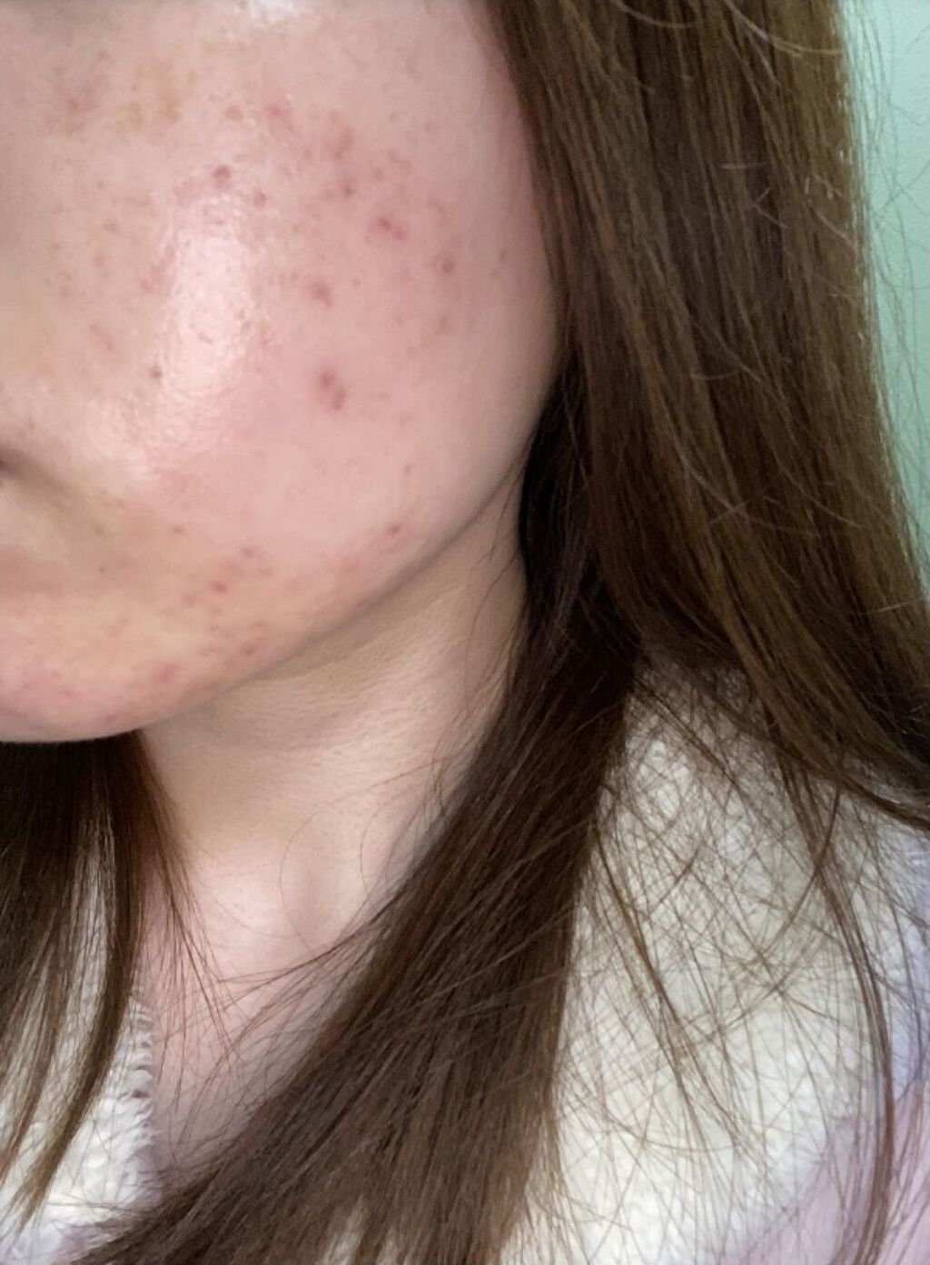 ペアアクネクリームW(医薬品)/ペア/その他を使ったクチコミ（3枚目）