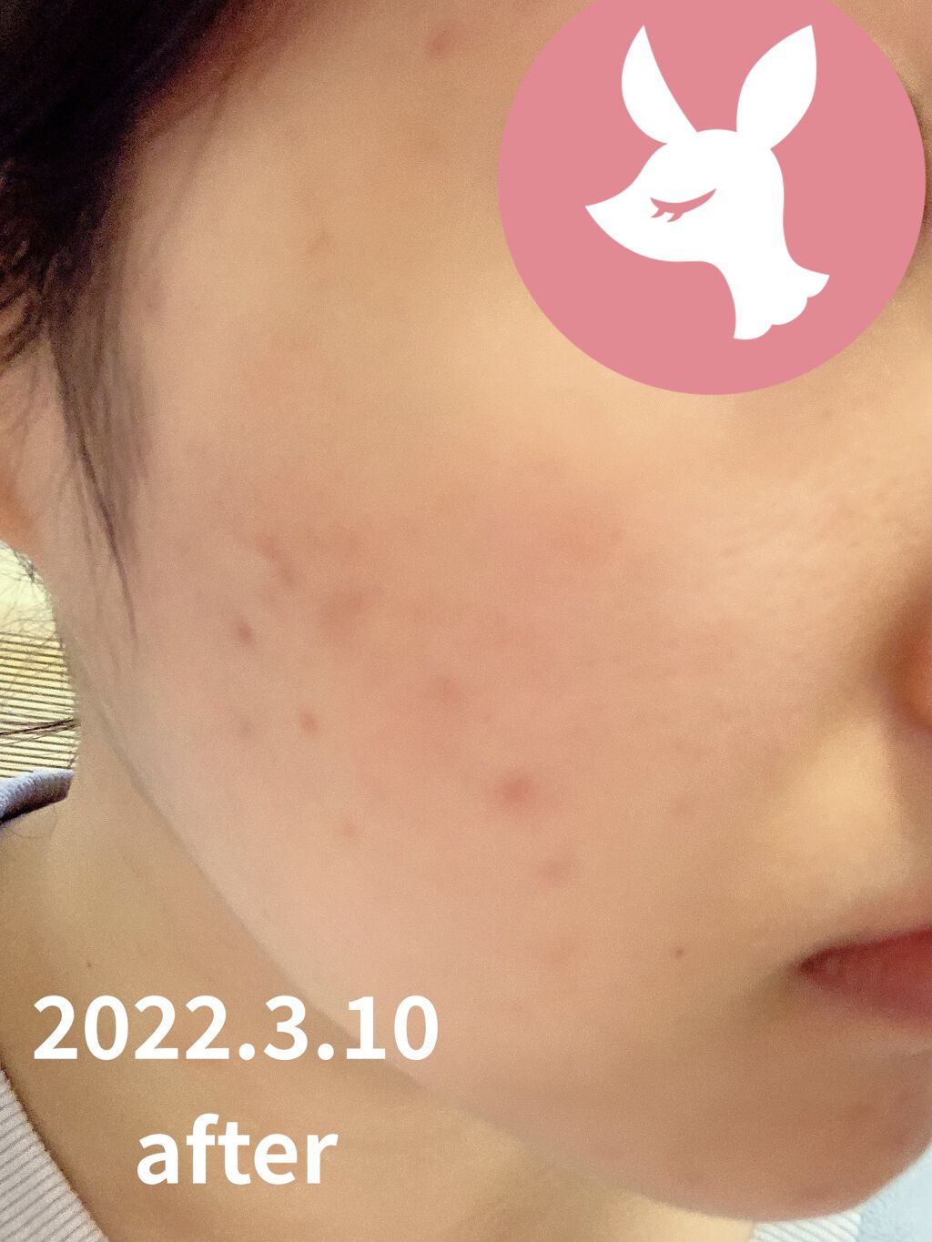 AHA 30% + BHA 2% Peeling Solution/The Ordinary/ピーリングを使ったクチコミ（2枚目）