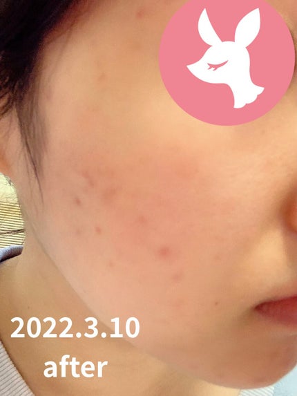 AHA 30% + BHA 2% Peeling Solution/The Ordinary/ピーリングを使ったクチコミ(2枚目)