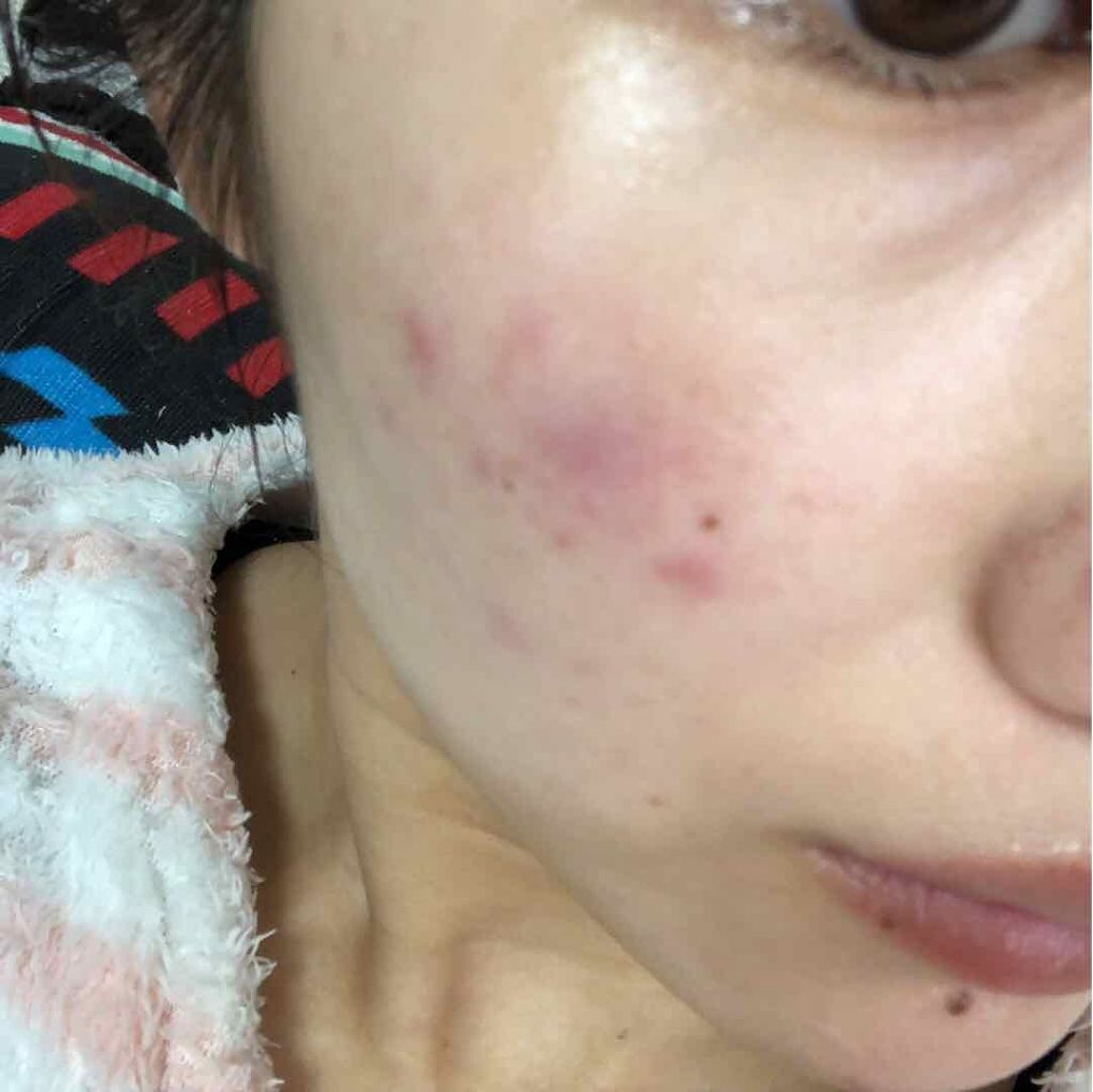 潤浸保湿 化粧水 III とてもしっとり/キュレル/化粧水を使ったクチコミ（1枚目）