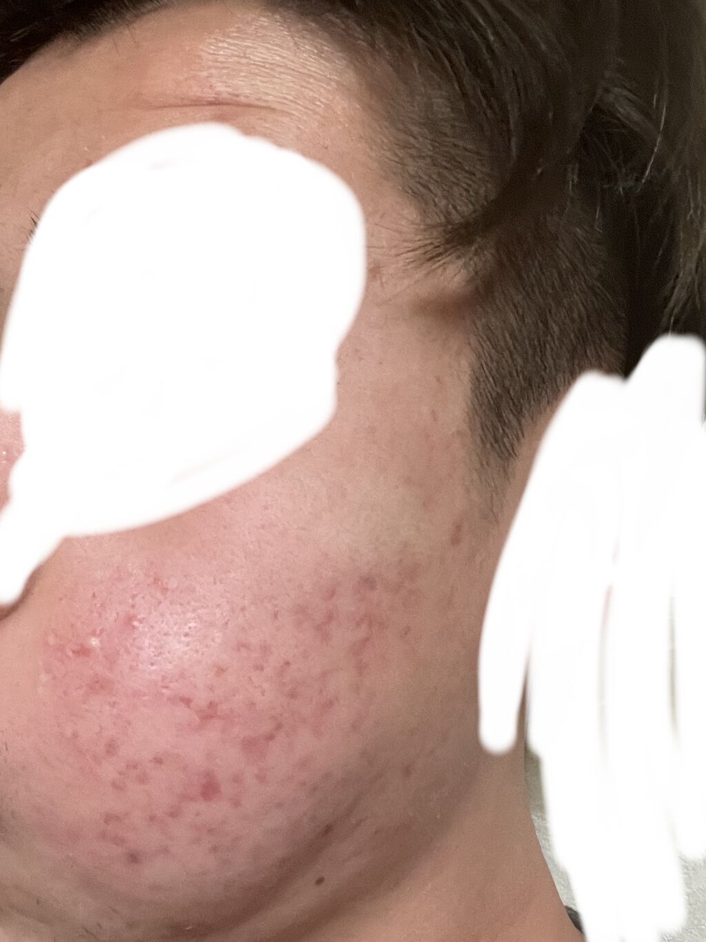 イソトレチノイン/イソトレチノイン/美容サプリメントを使ったクチコミ（3枚目）