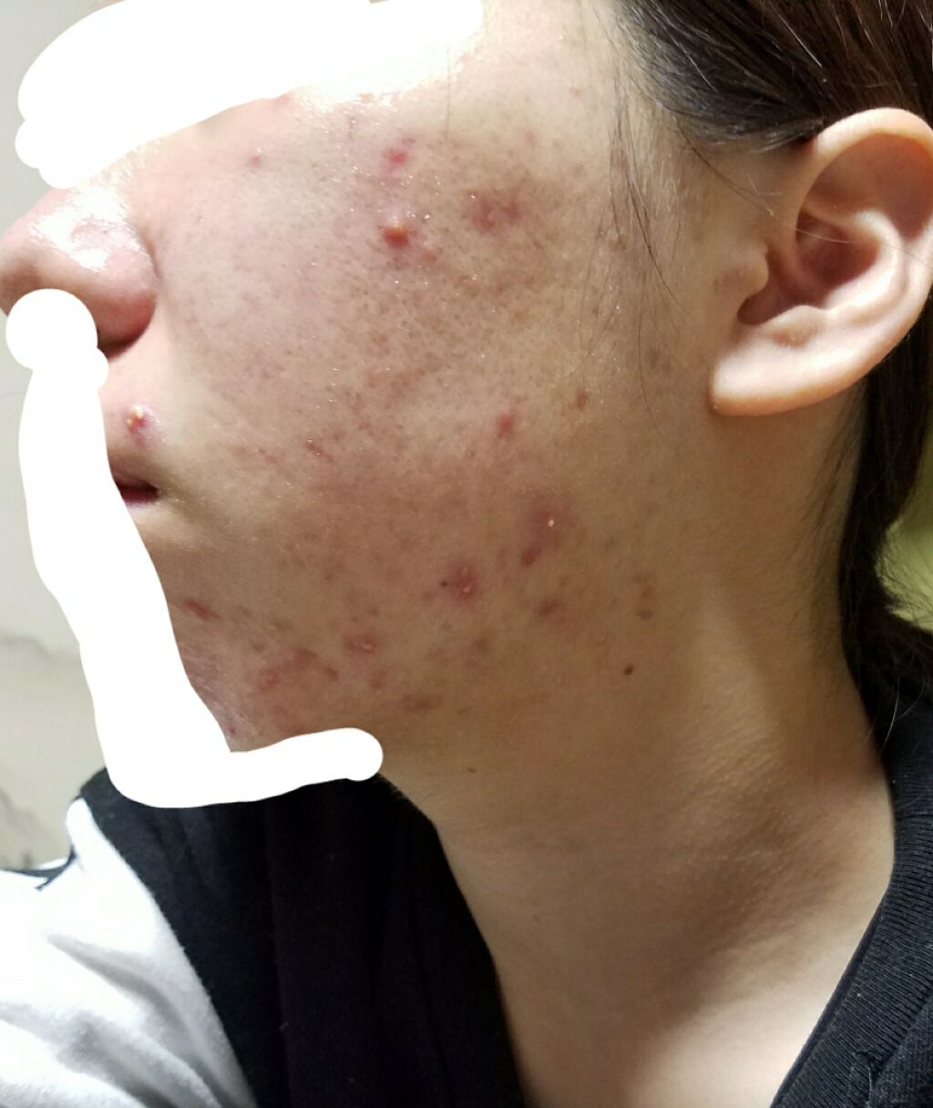 さりあ on LIPS 「治る気がしません。汚い肌を本当にすみません。経過メモのために一..」(1枚目)