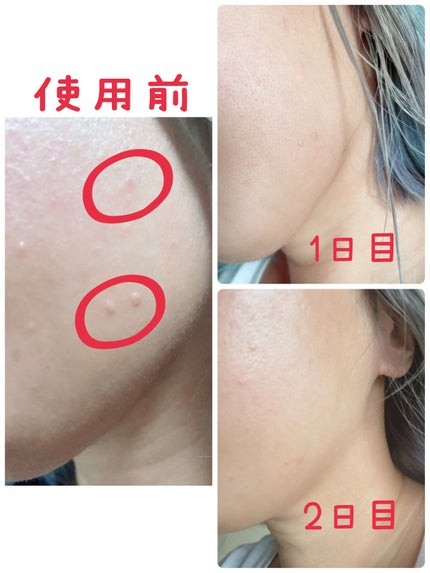 ミラクルアクネクリアスポットトリートメント/SOME BY MI/美容液を使ったクチコミ(4枚目)