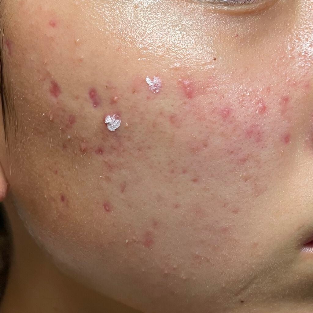 ドクタージャルト コントロールA ティーツリーメントスージングスポット/Dr.Jart+/その他スキンケアを使ったクチコミ(2枚目)