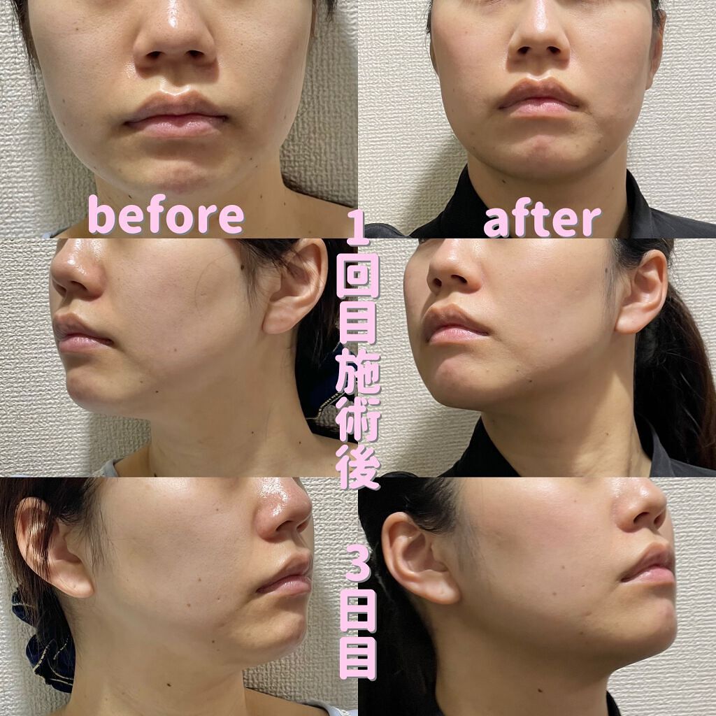 Tomomi on LIPS 「はじめての美容医療〜脂肪溶解リニアHIFU〜1回目施術後3日目..」(4枚目)