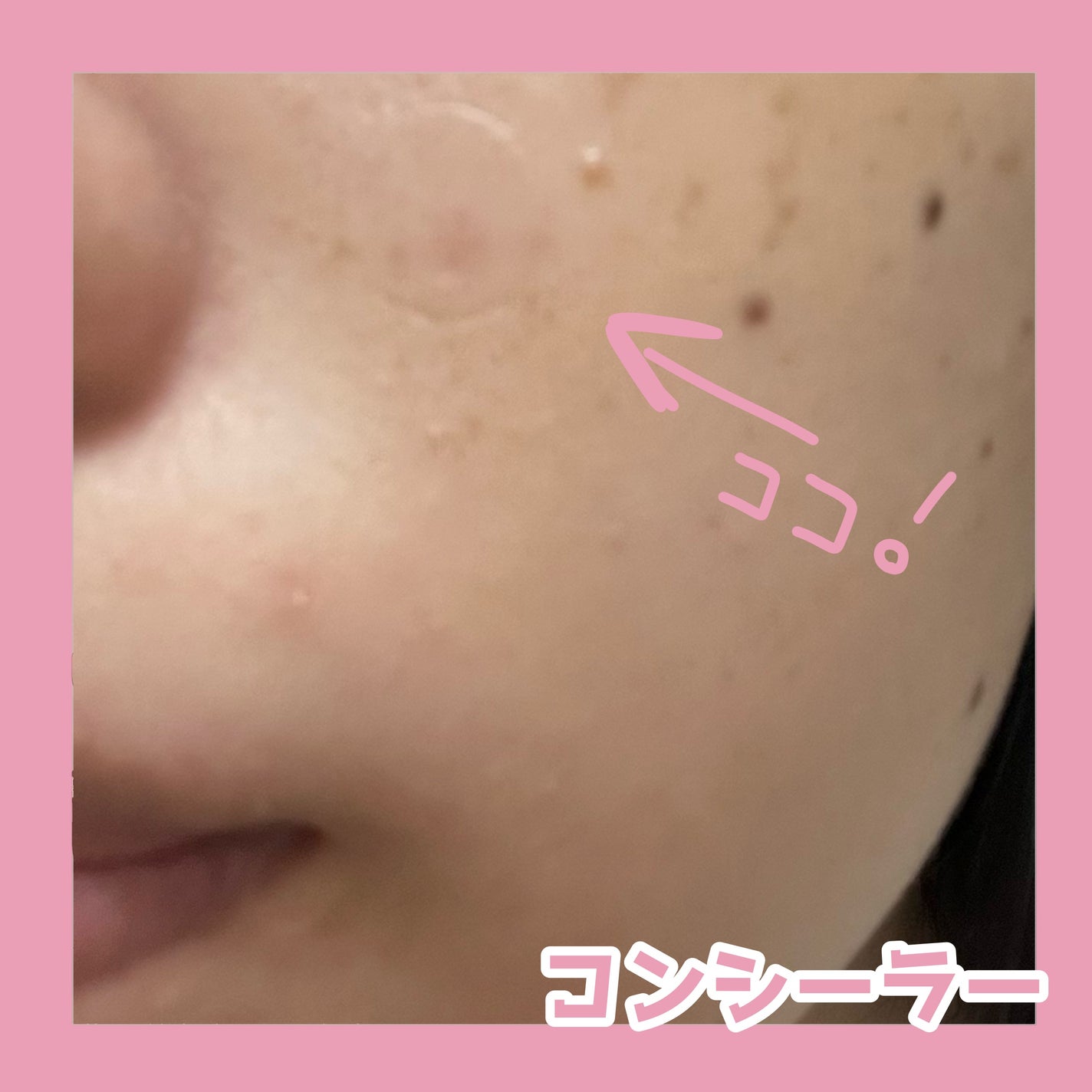 極薄透明パッチ nikipa!/金冠堂/にきびパッチを使ったクチコミ(5枚目)