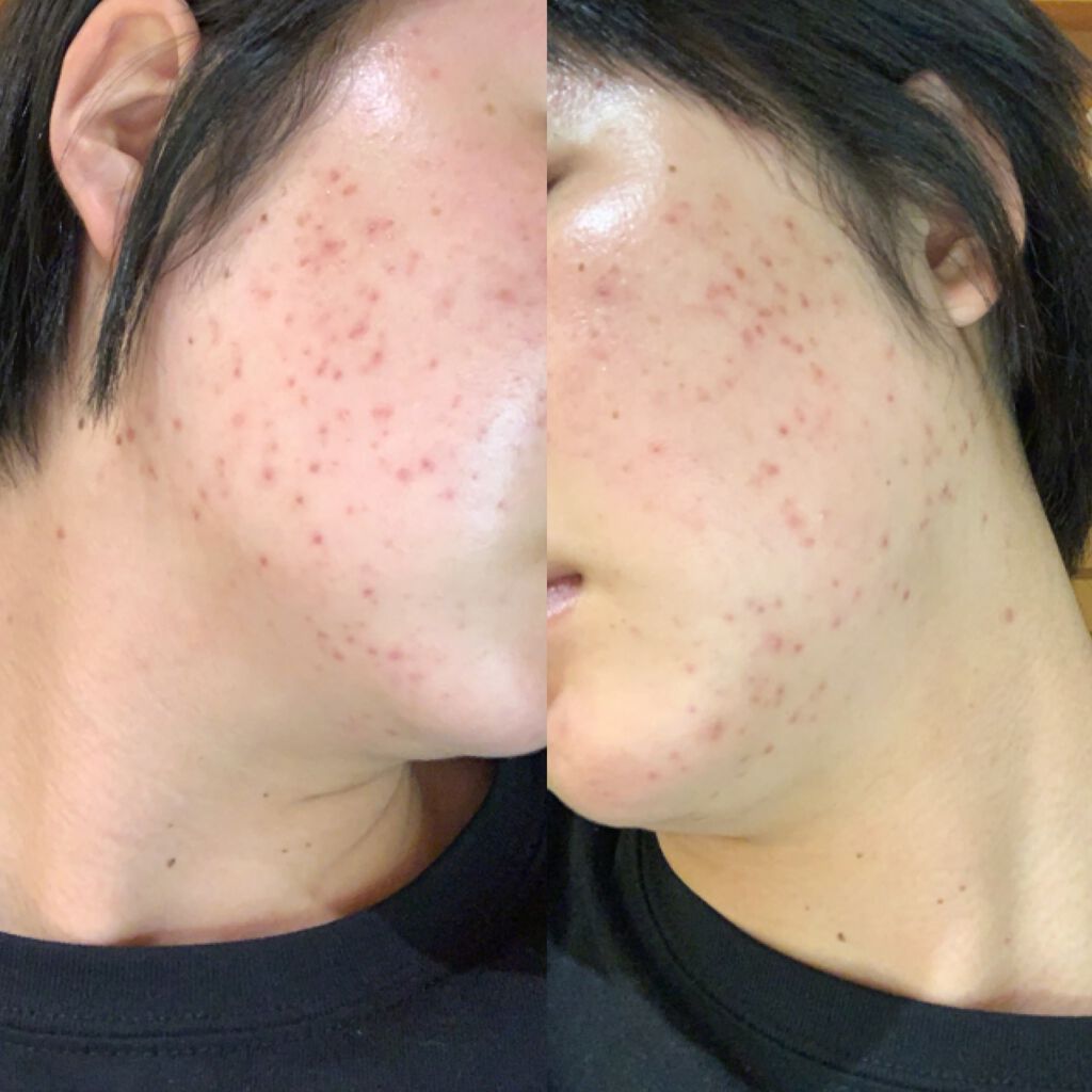 Cセラム/b.glen/美容液を使ったクチコミ（3枚目）