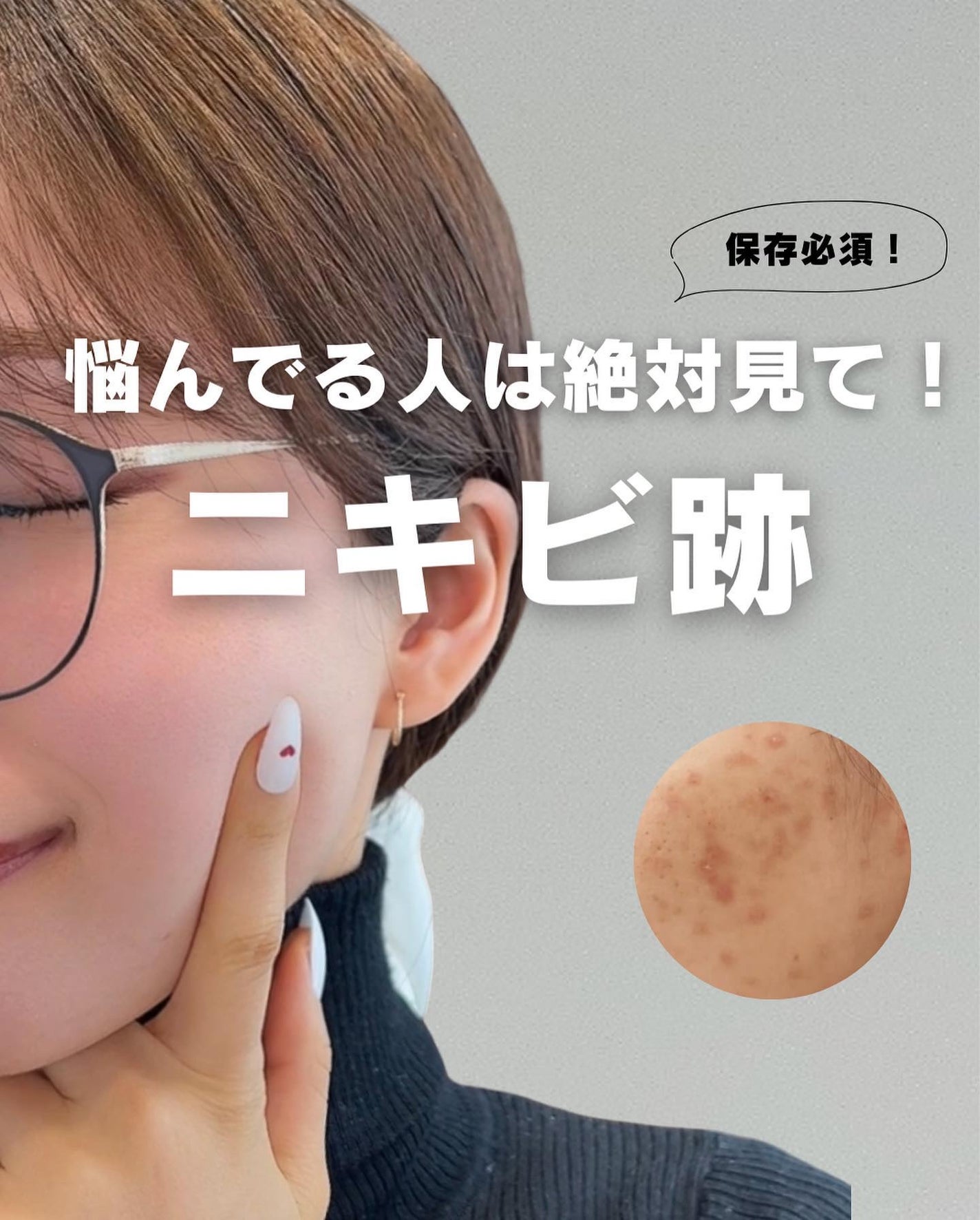 白湯(サユ) | ニキビと戦うOL🤍 on LIPS 「ニキビ跡ってどうやったら治るの😭😭って人集合!ニキビ跡って気..」(1枚目)