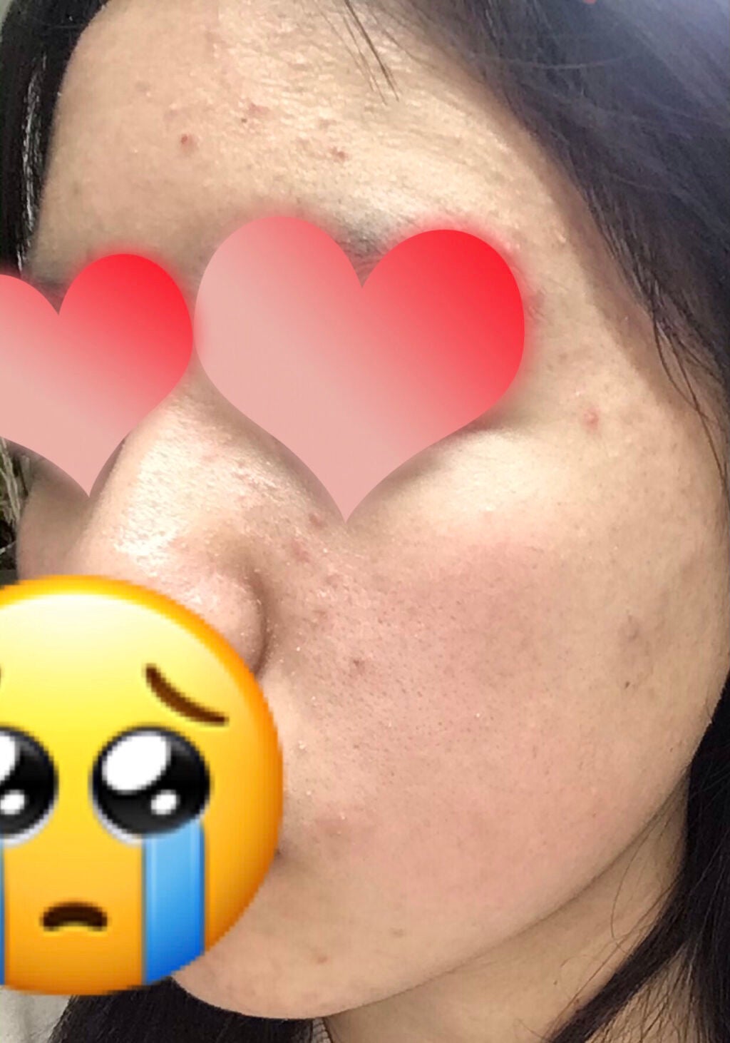 みかわん✨ on LIPS 「助けてください💦ニキビが、治らなくて……😦💦今は、プロアクティ..」(2枚目)