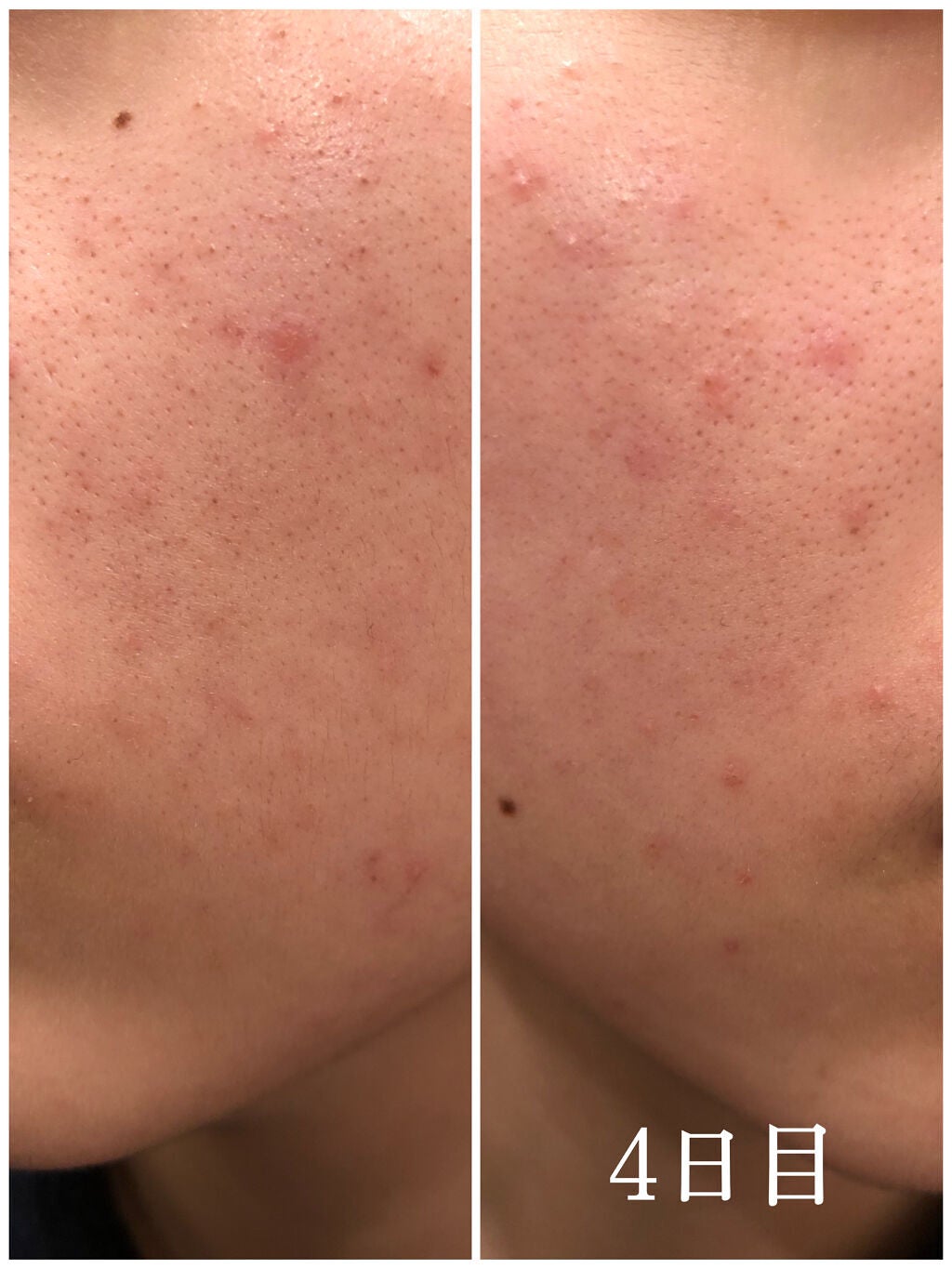 DHC はとむぎエキス/DHC/健康サプリメントを使ったクチコミ(4枚目)