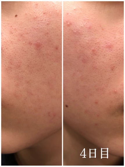 DHC はとむぎエキス/DHC/健康サプリメントを使ったクチコミ(4枚目)