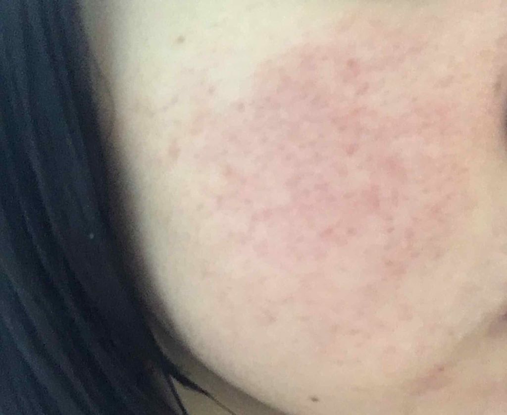 ぶたん on LIPS 「皮膚科に行って塗り薬もらいました。でも、今まで通り化粧水をして..」(1枚目)