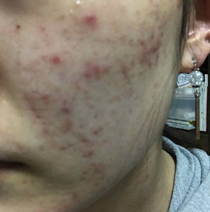 AHA·BHA·PHA 30デイズミラクルトナー/SOME BY MI/化粧水を使ったクチコミ(3枚目)