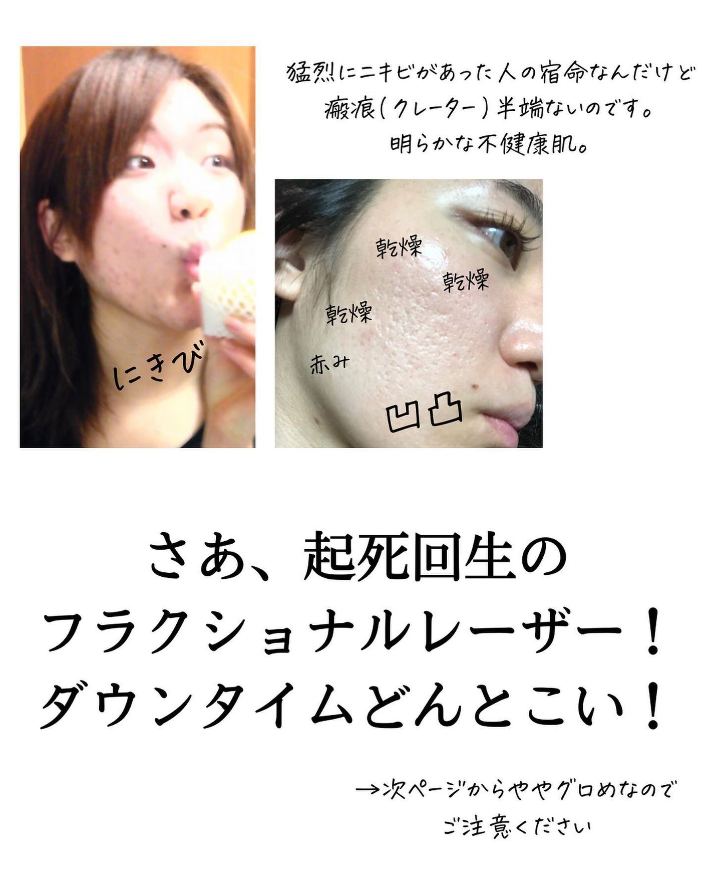 おゆみ|ニキビ・ニキビ跡ケア on LIPS 「【しくじり先生②早まるな、肌爆撃!💣】こんばんは、おゆみです💁..」(4枚目)