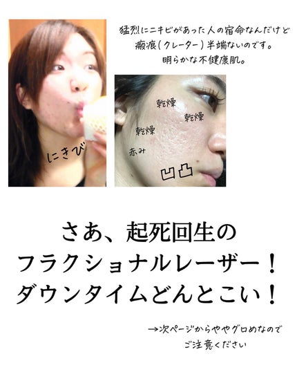おゆみ|ニキビ・ニキビ跡ケア on LIPS 「【しくじり先生②早まるな、肌爆撃!💣】こんばんは、おゆみです💁..」(4枚目)