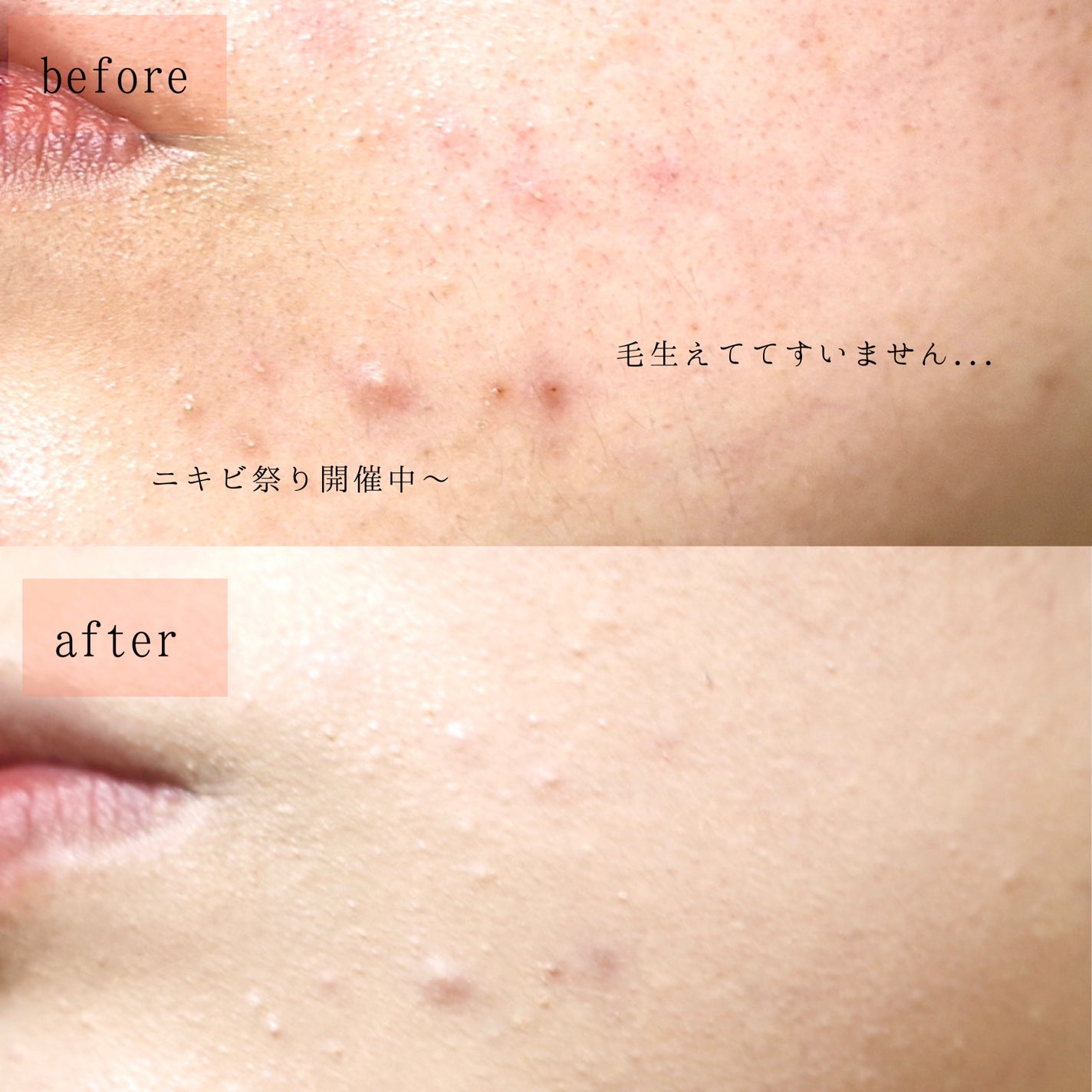 ピンクティーツリーカバーアップグロウクッション/APLIN/クッションファンデーションを使ったクチコミ(5枚目)