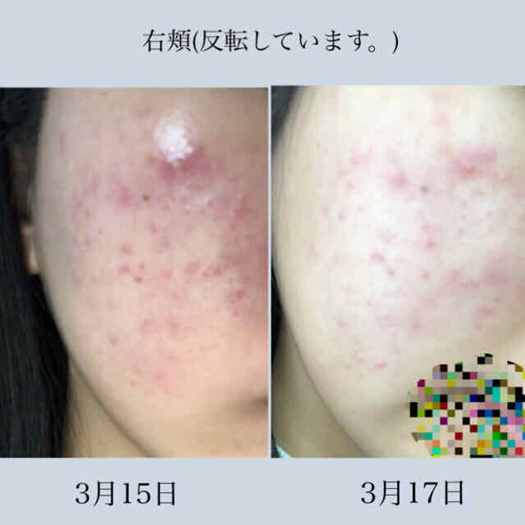 バイオイル/バイオイル/フェイスオイルを使ったクチコミ（2枚目）