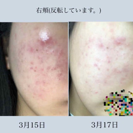 バイオイル/バイオイル/フェイスオイルを使ったクチコミ(2枚目)