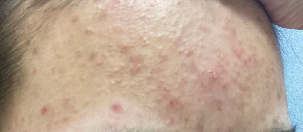 fresh_lips_jkd1 on LIPS 「とても汚い肌をお見せしてしまい申し訳ありません(--;)ニキビ..」(2枚目)