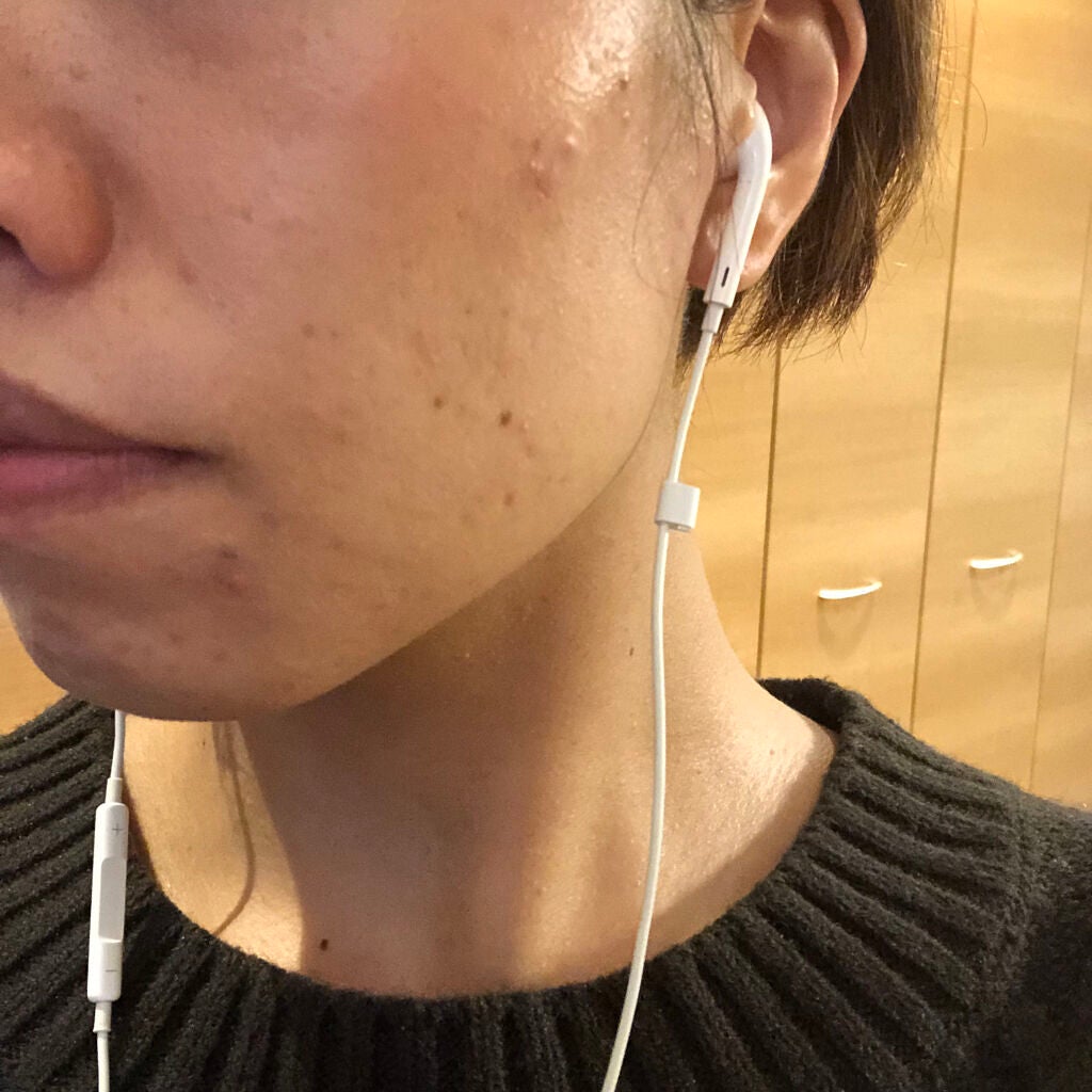 りんにゃ~フォロバ100🙆🏼♀️~🔰 on LIPS 「#低用量ピル3週間め耳下のニキビが小さくなってきた。でもまた生..」(3枚目)