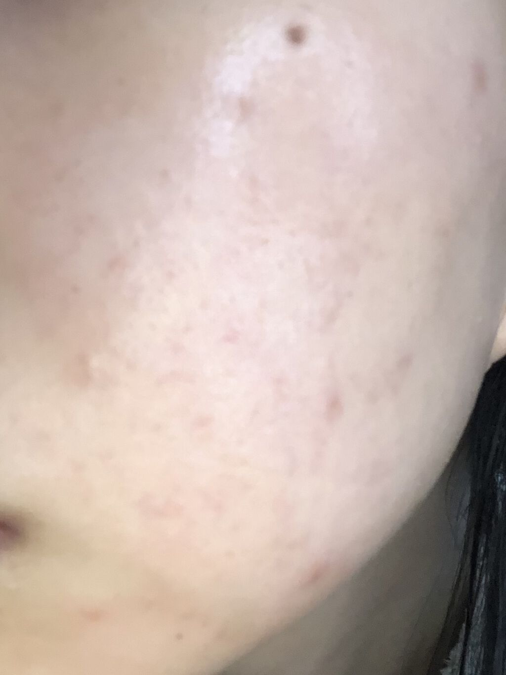 ベピオゲル/マルホ株式会社/その他を使ったクチコミ（2枚目）