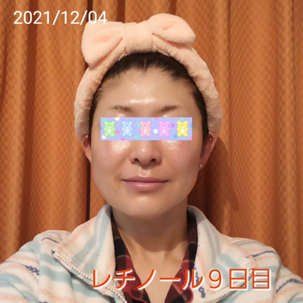 トレチノインジェル/A-Ret/美容液を使ったクチコミ（1枚目）