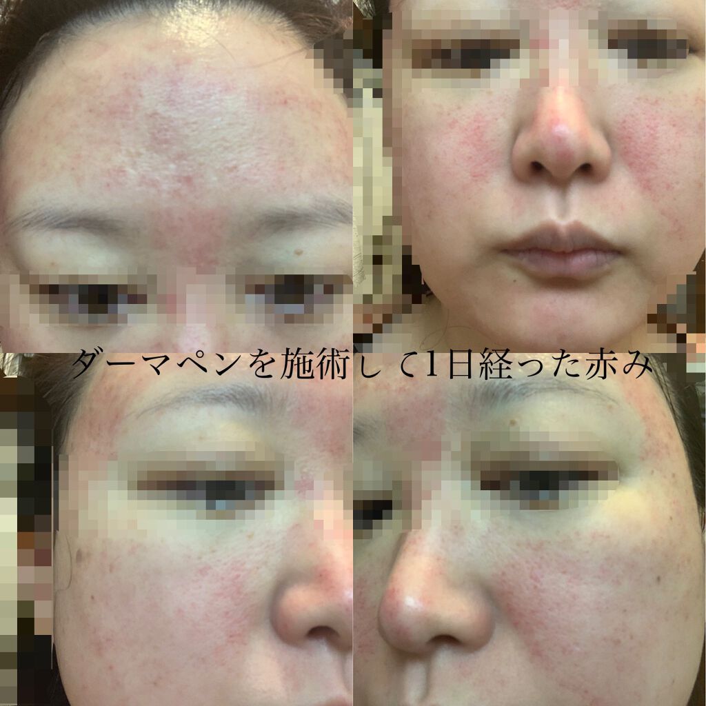 asu.fuji on LIPS 「初めてダーマペン4を土曜日に受けてきました。受けた目的は、オデ..」(4枚目)