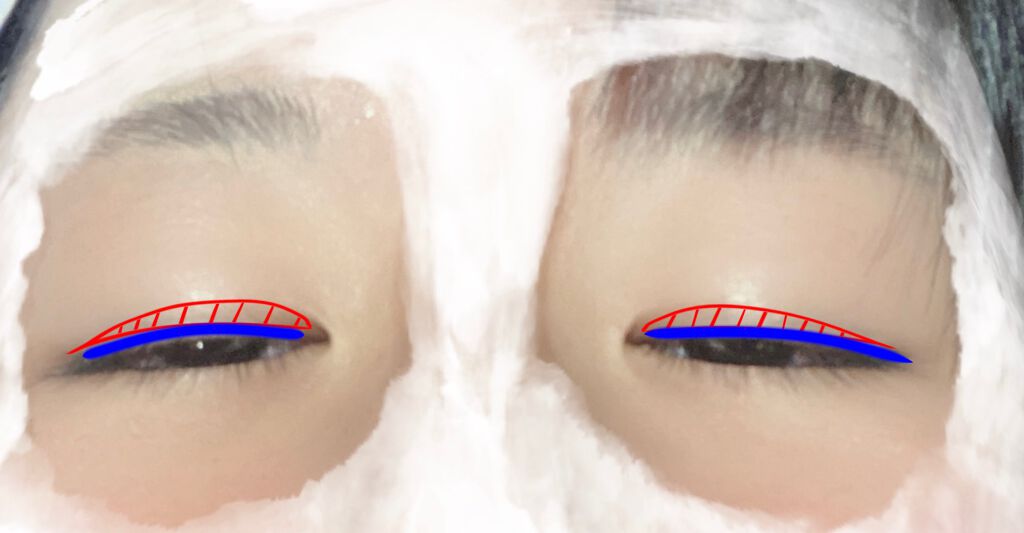 ぱっちり幅広アイテープ/DAISO/二重まぶた用アイテムを使ったクチコミ(3枚目)