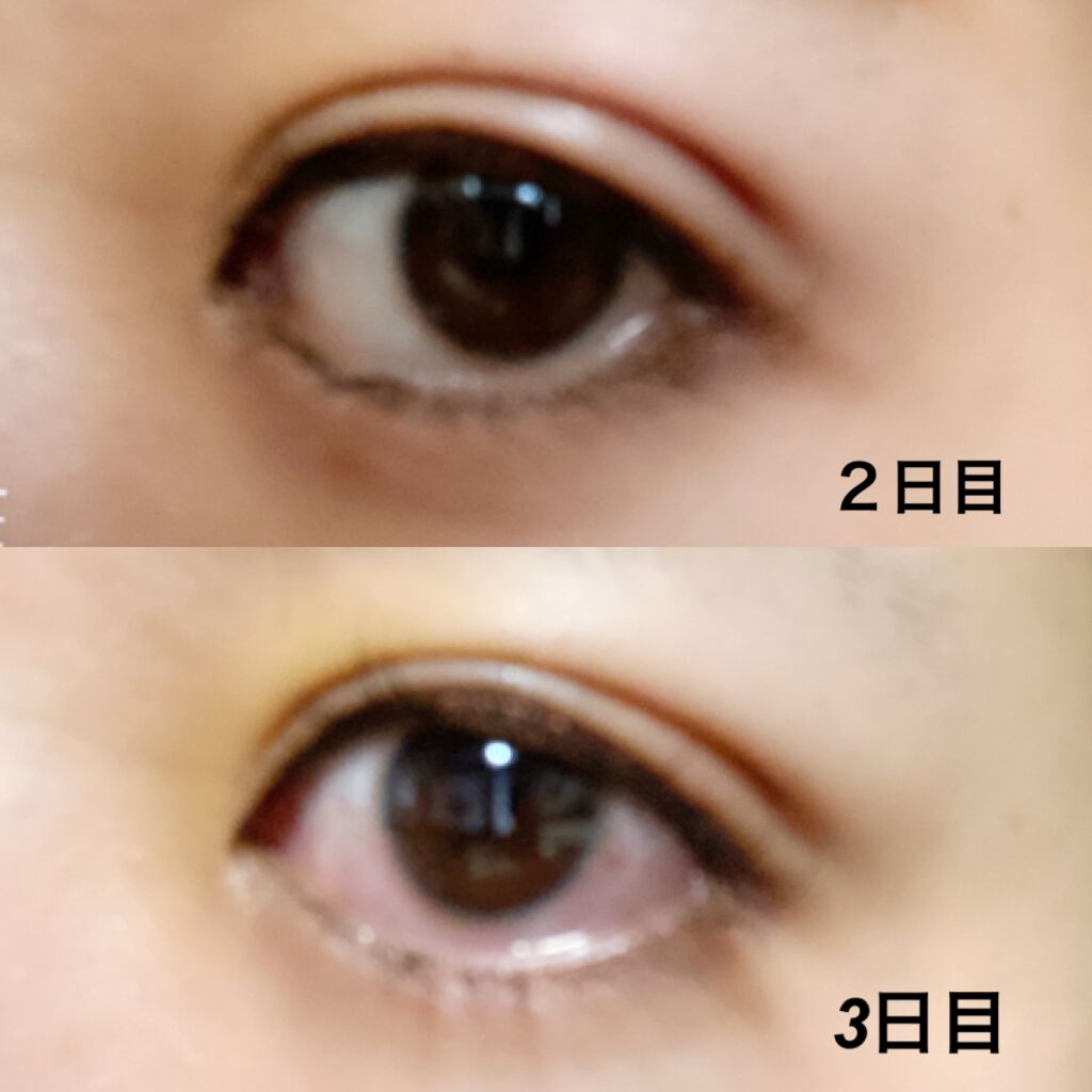 ちび☺︎ on LIPS 「脱☆一重!念願の埋没してきました、、、!二重整形を考えている方..」(3枚目)