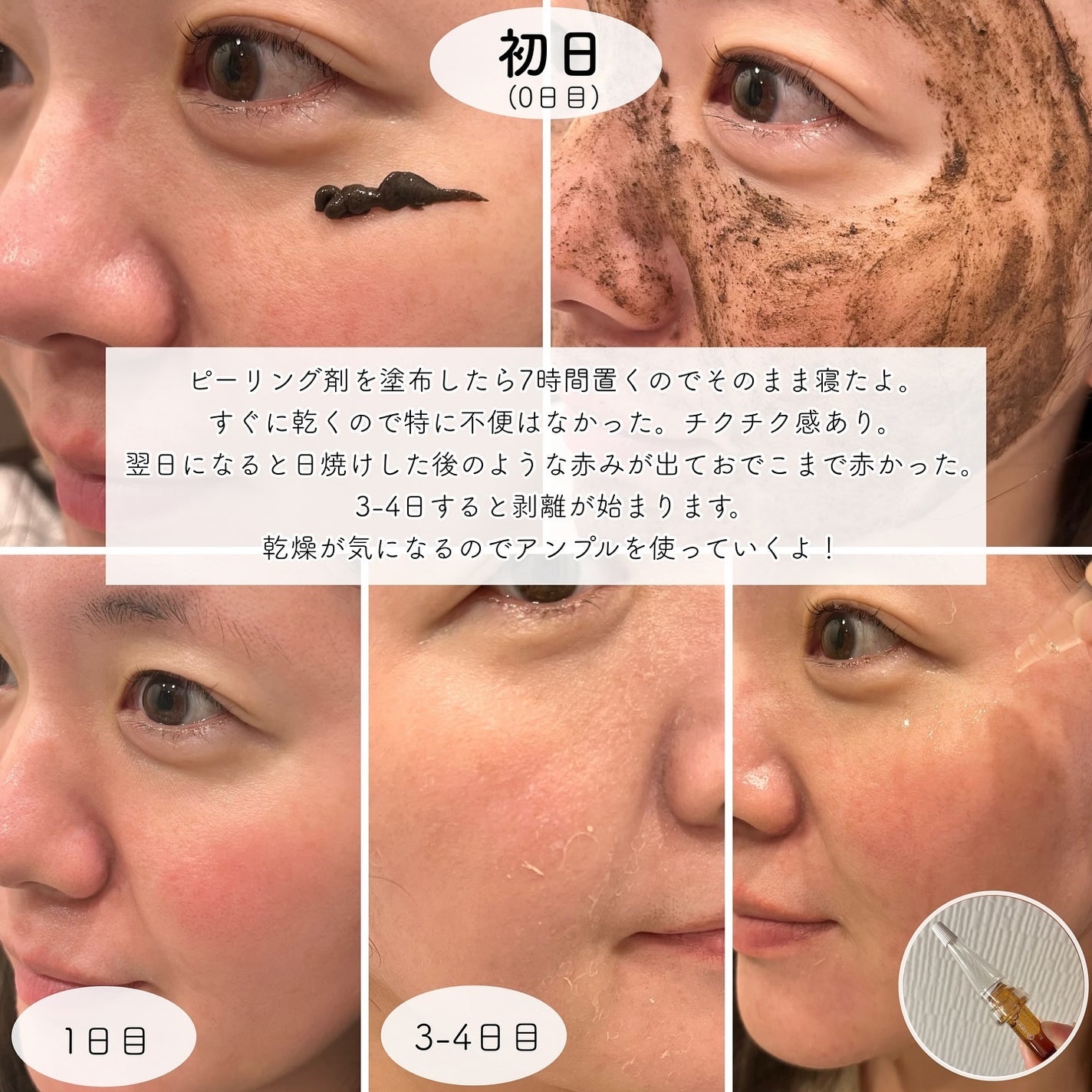 ダーマスキンピーリング|BQCELLの口コミ - 自宅でできる ダーマスキンピーリング|BQCELLの口コミ - 自宅でできる