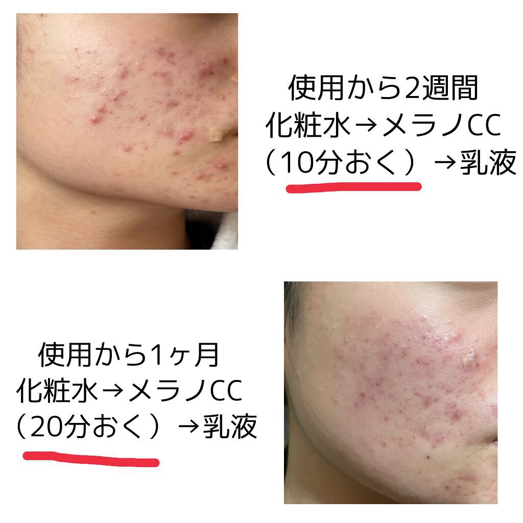 薬用 しみ 集中対策 美容液/メラノCC/美容液を使ったクチコミ（2枚目）