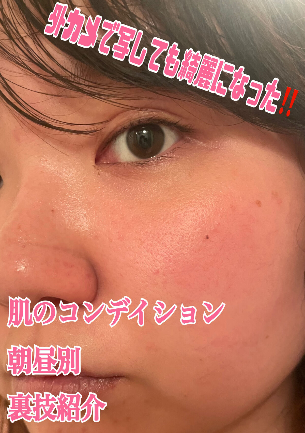 ペアアクネクリームW(医薬品)/ペア/その他を使ったクチコミ（1枚目）