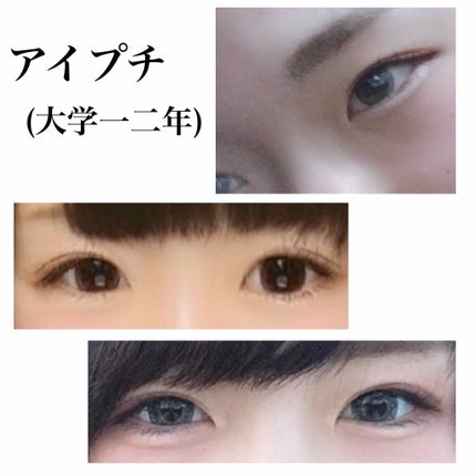 二重整形/その他を使ったクチコミ(3枚目)