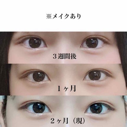 二重整形/その他を使ったクチコミ(3枚目)