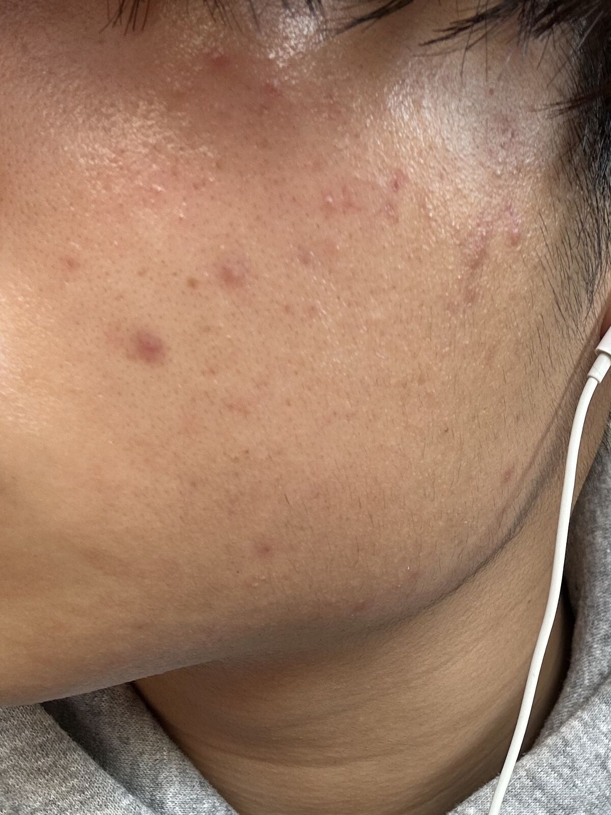 薬用しみ集中対策 プレミアム美容液/メラノCC/美容液を使ったクチコミ（2枚目）