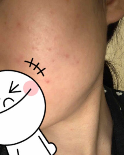 ディフェリンゲル0.1% /マルホ株式会社/その他を使ったクチコミ(2枚目)