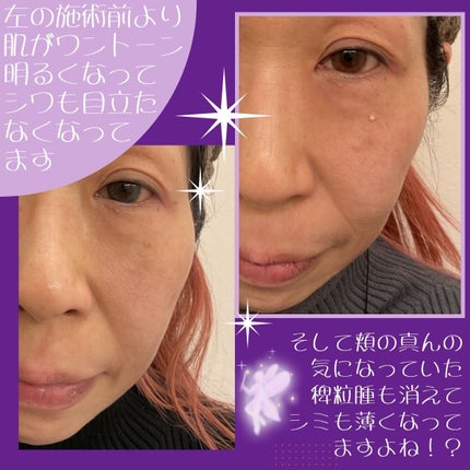 瞳子うさぎ@定期的に投稿ある方フォロバ on LIPS 「めちゃくちゃ興味のあったダーマペンと水光注射を、昨年11月オー..」(4枚目)