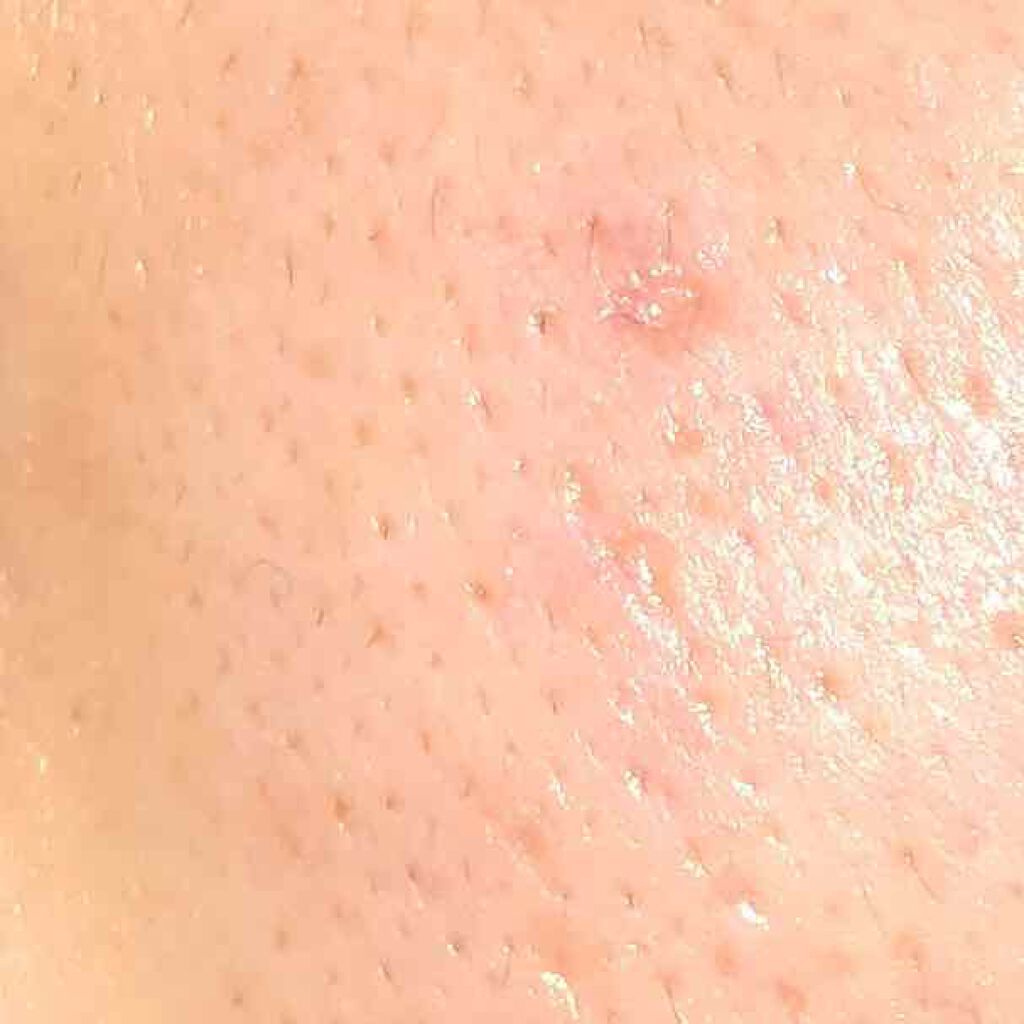 クラリファイング ローション 2/CLINIQUE/拭き取り化粧水を使ったクチコミ（2枚目）