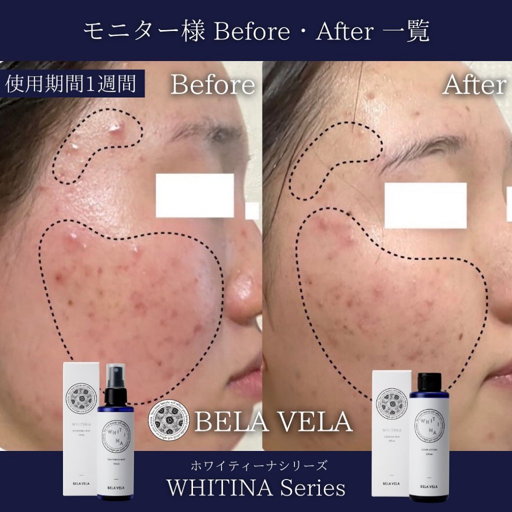 【効果実感100%】ホワイティーナモニター様のBefore After一覧
⁡
いつもBELA VELAをご愛顧くださりありがとうございます😌
⁡
先日募集させていただいたホワイティーナのモニターが終了したので、
モニター様のBefore