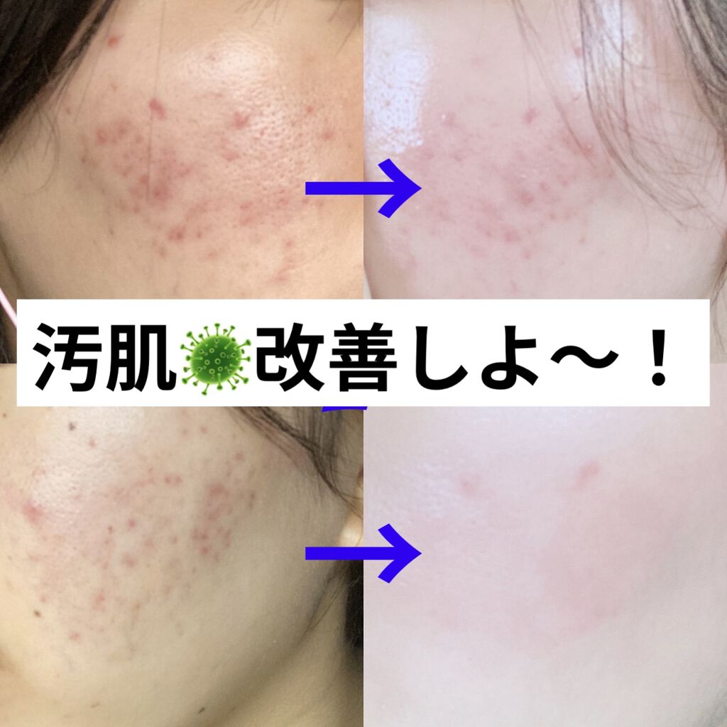 DHC ビタミンＣハードカプセル/DHC/美容サプリメントを使ったクチコミ（1枚目）