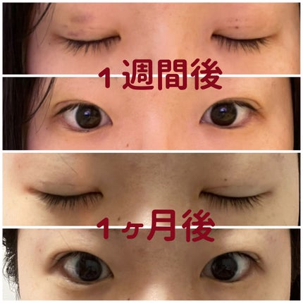 ゆー on LIPS 「湘南美容外科でスクエア二重術していただきました!初めてで、めち..」(4枚目)