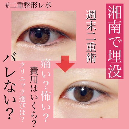 二重整形/その他を使ったクチコミ(1枚目)