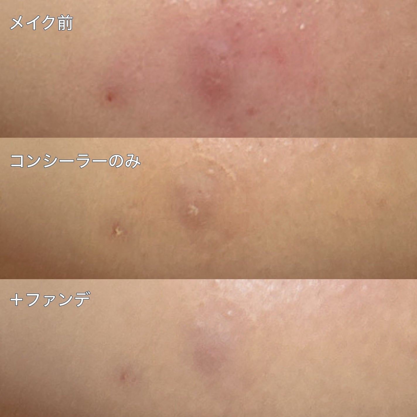 薬用コンシーラー アクネプロテクター/ONLY MINERALS/パウダーコンシーラーを使ったクチコミ(4枚目)