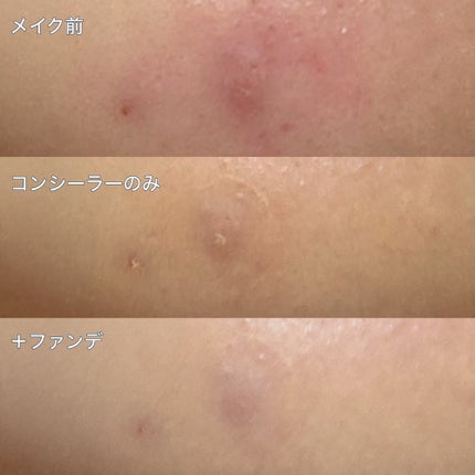 薬用コンシーラー アクネプロテクター/ONLY MINERALS/パウダーコンシーラーを使ったクチコミ(4枚目)