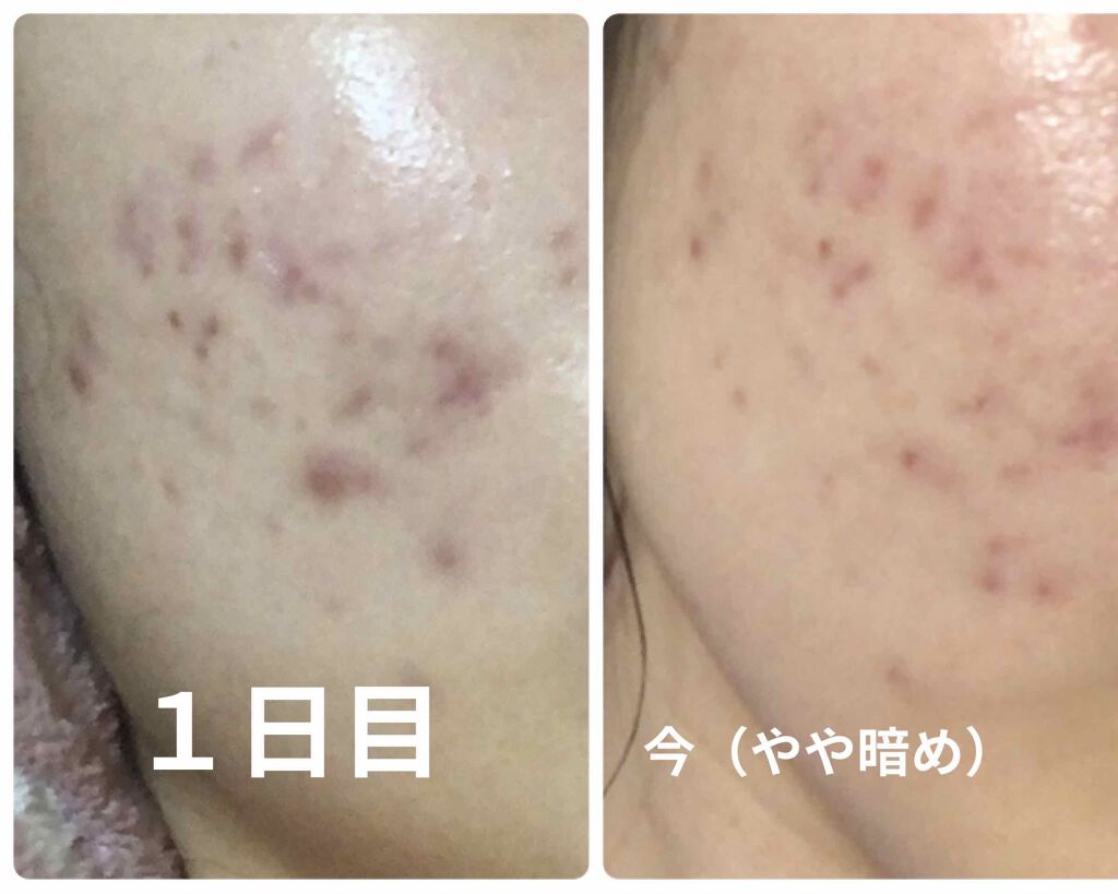 アポスティークリーム(医薬品)/アポスティー/その他を使ったクチコミ(3枚目)