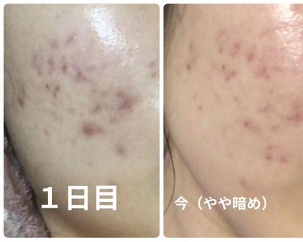 ミノン アミノモイスト 薬用アクネケア ローション/ミノン/化粧水を使ったクチコミ(3枚目)